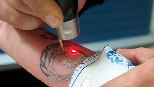 Laser – The New Technology For Tattoo Moving!