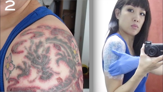Tca Tattoo Removal – Removing A Tattoo Through Your Forearm