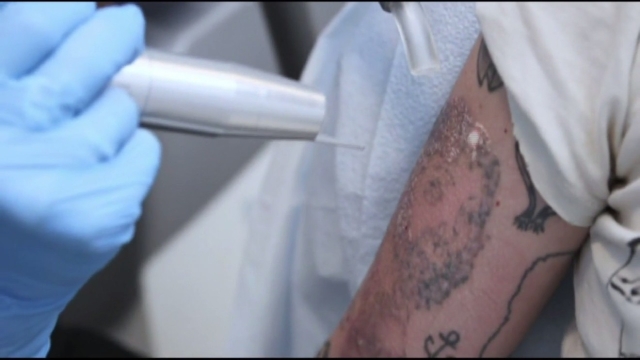 Why Back Tattoo Removal Is Ever-Increasing
