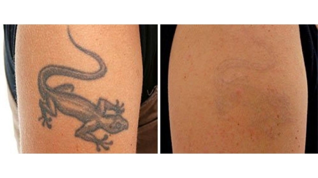 Outgrown Your Tattoo? Period For Get Associated With It With Tca