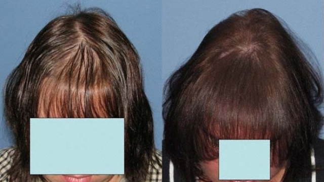 Revitalizing Your Look: Unleashing the Confidence of Hair Implants