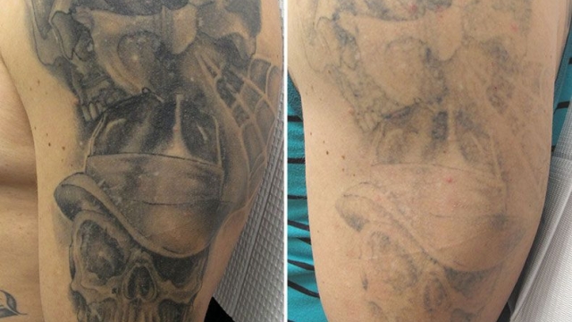 Wrecking Balm Tattoo Removal