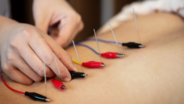 The Healing Art of Acupuncture: Restoring Balance and Promoting Well-being